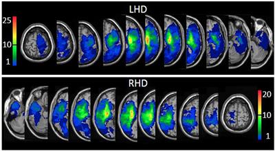 Lesion Topography Impact on Shoulder Abduction and Finger Extension Following Left and Right Hemispheric Stroke